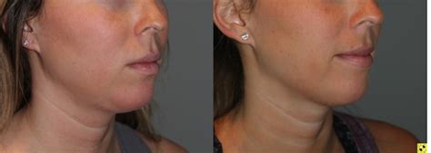 🥇 Atlanta Kybella Before And After Pictures Photo Gallery Buckhead