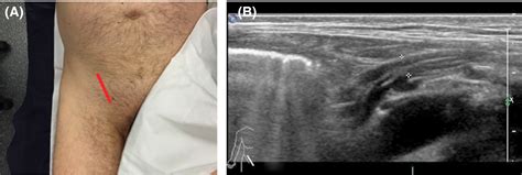 Evaluation Of Hernia Of The Male Inguinal Canal Sonographic Method Jansen Journal Of