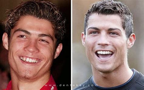 Ronaldos Teeth And Smile Makeover Dentakay