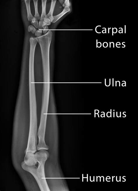 Radius And Ulna X Ray