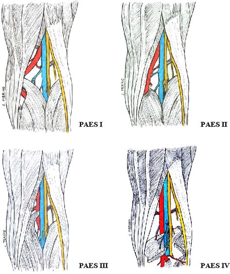Popliteal Artery Entrapment Eight Years Experience Ejves Extra