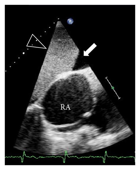 31 Year Old Patient With Tricuspid Atresia Atrial And Ventricular