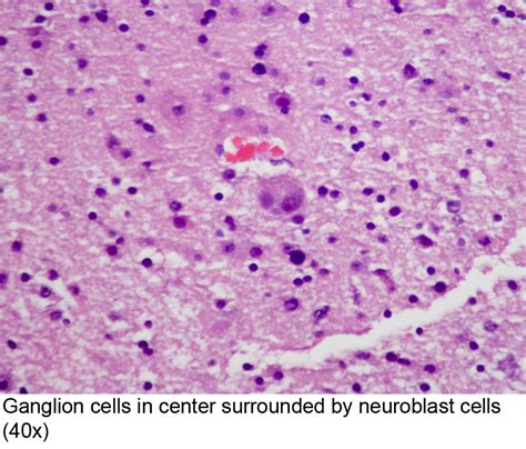 Pathology Outlines Ganglioneuroblastoma