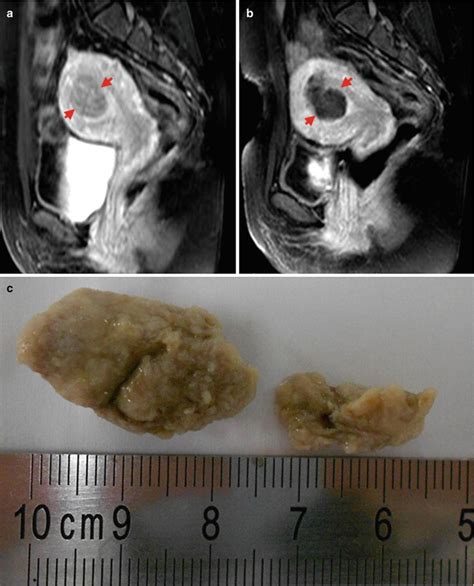 Microwave Ablation For Symptomatic Uterine Fibroids Radiology Key