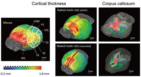 D Surface Maps Showing Cortical Thickness And Images Of Corpus