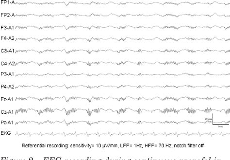 Myoclonic Status Epilepticus Following Repeated Oral Ingestion Of