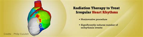 Noninvasive Radiation Therapy To Treat Life Threatening Heart Rhythm