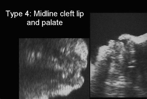Ultrasound Of Cleft Lip And Palate 863