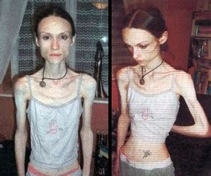 Volne pokracovanie supermonika estranky cz Téma č 1 Anorexia