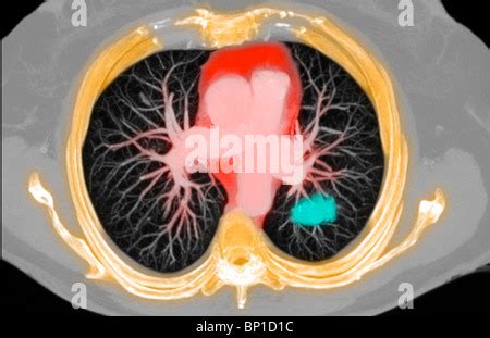 Ct Scan Axialer Abschnitt Zeigt Einen Krebs In Der Rechten Lunge Eine