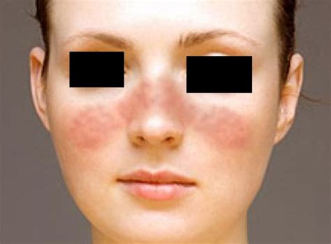 Stress Rash Causes Symptoms Pictures And Treatment Hubpages