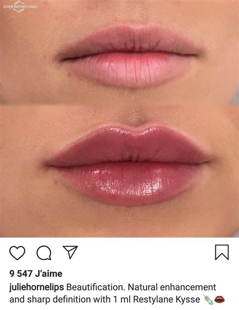 perfect lipsfillers perfect lip fillers botox lips lip injections