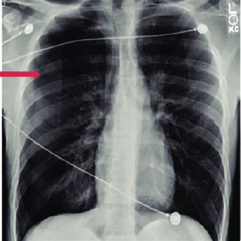 Ct Scan Of Chest Showing Pneumothorax And Small Bullae In Right Upper