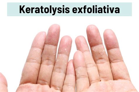 Exfoliative Dermatitis Hands