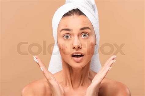 Surprised Nude Girl In Towel With Acne On Face Looking At Camera