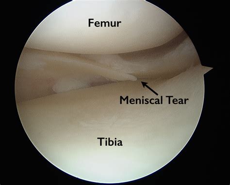 Torn Meniscus Anatomy And Causes Video Jeffrey H Berg Md