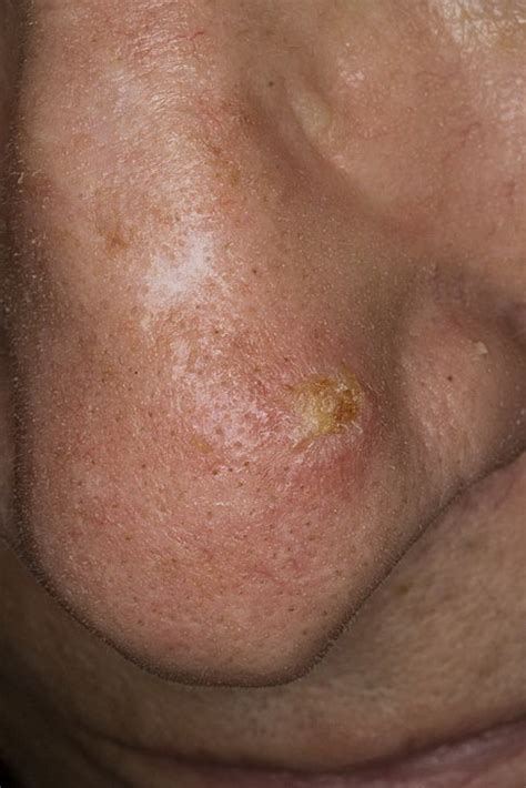 Skin Cancer On Nose Pictures 12 Photos And Images