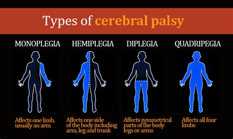 Spastic cerebral palsy is the most common type of cerebral palsy. Living with cerebral palsy - The perfect child