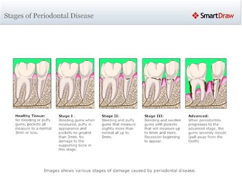 Pin By Heather Calverley On Dental Periodontitis Periodontal Disease Dental Hygiene School