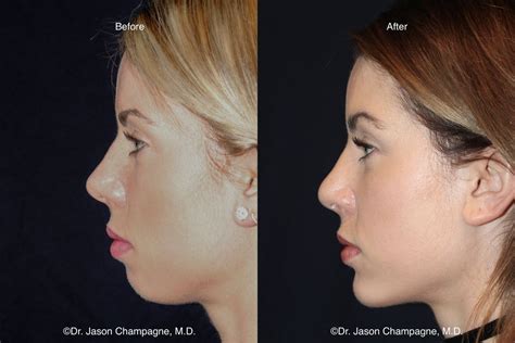 Angelina Jolie Profile Before After Chin Implant And