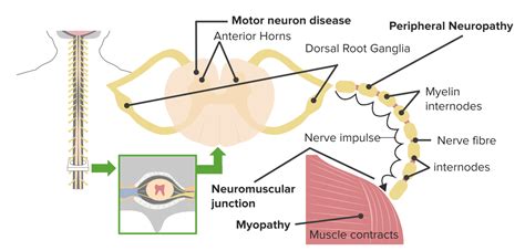 Types Of Neuromuscular Disease