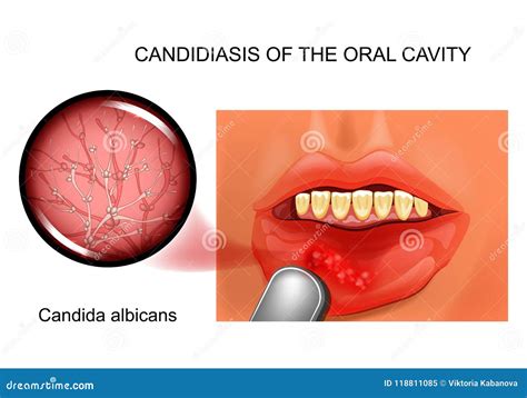 Candidiasis Of The Oral Cavity Stock Vector Illustration Of Disease Face