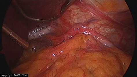 Paraesophageal Hernia Before Reduction Sages Image Library