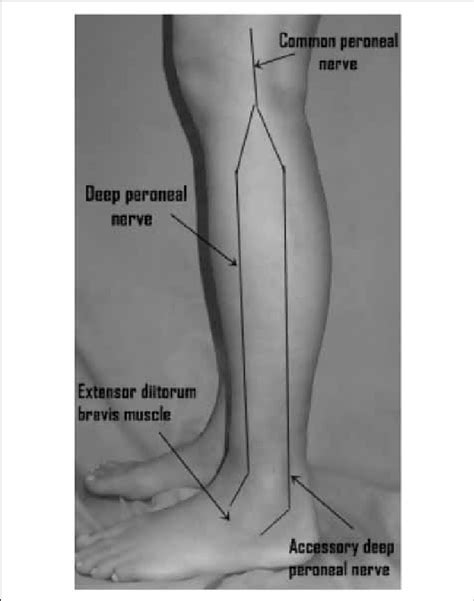 The Accessory Deep Peroneal Nerve Download Scientific Diagram