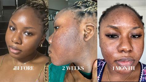 Professional Chemical Peel Gone Wrong Skin Purging After A Chemical
