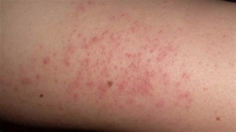 Raised Skin Bumps Pictures Causes And Treatment
