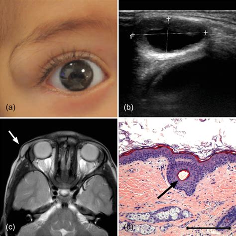 A 10 Month Old Infant Diagnosed With A Superotemporal Dermoid Cyst B