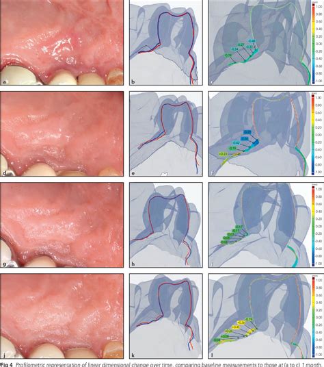 PDF Three Dimensional Volumetric Analysis Of The Palatal Donor Site