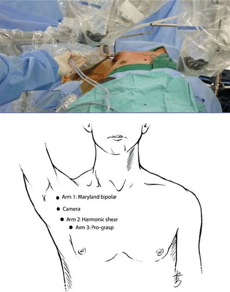 Top The Transaxillary Approach For Robotic Thyroidectomy Bottom