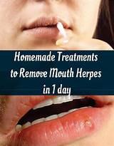 Holistic Treatment Herpes Photos