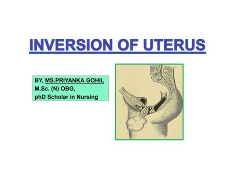 Inversion Of The Uterus Ppt