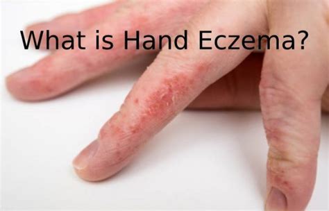 What Is Hand Eczema Produced Treatment And More