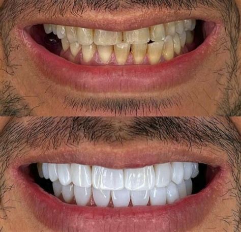 Implante Dentario Antes E Depois