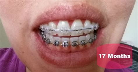 Mom Gets Braces Know When To Hold Em 9