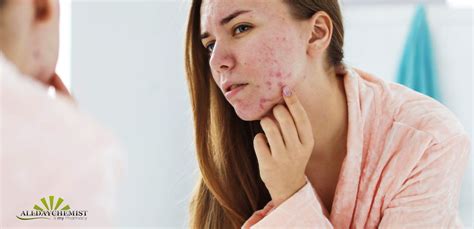 Learn How To Clear Severe Acne All Day Chemist