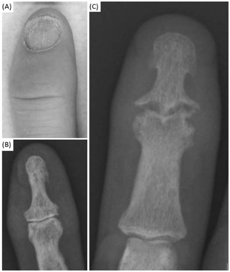 Psoriatic Nail Dystrophy Is Associated With Erosive Disease In The