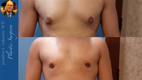Incredible 3 Weeks Gynecomastia Before And After Gland Removal By Dr Lebowitz Long Island New