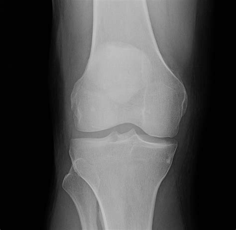 Orthodx Medial Compartment Knee Arthritis