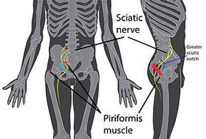 Piriformis Syndrome A Real Pain In The Butt