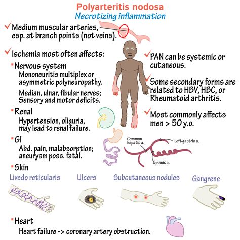 Pathology Glossary Polyarteritis Nodosa Draw It To Know It