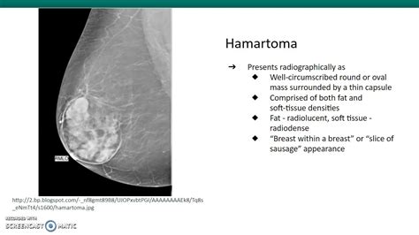 Fibroadenoma Vs Hamartoma YouTube