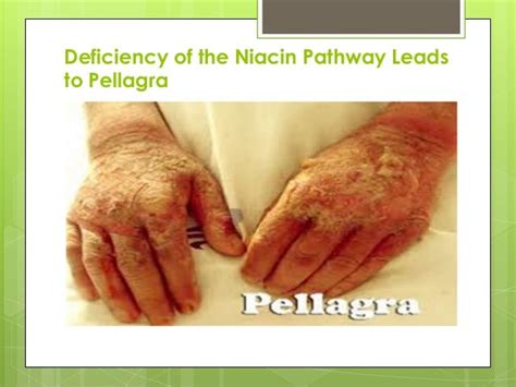 Deficiency Of The Niacin Pathway