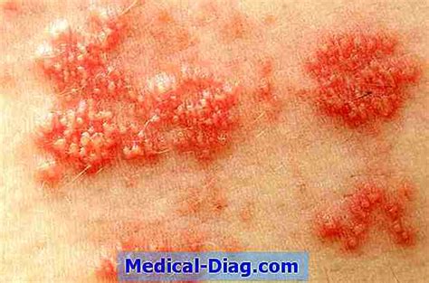 Bältros orsakas av att vilande vattkoppsvirus (varicella zoster) återaktiveras. Är Det Bältros? Bilder Och Symtom (Medical-Diag.com 2021)