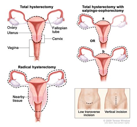 radical hysterectomy (Patient) - Siteman Cancer Center