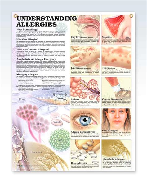 Laminated Allergies Human Anatomy Posters