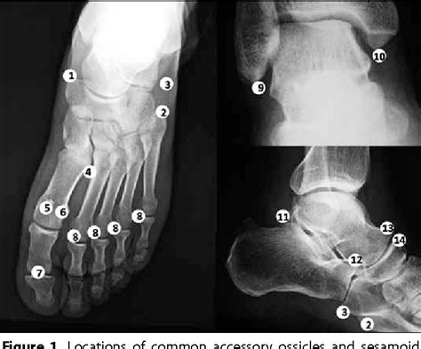 Figure 1 From The Accessory Ossicles Of The Foot And Ankle A